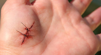 Hand with stitches