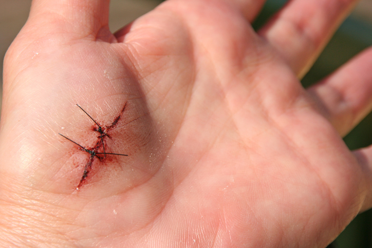 Hand with stitches