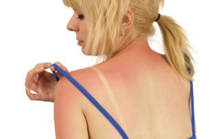 A woman examines sunburn on her shoulder