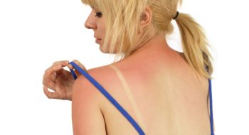 A woman examines sunburn on her shoulder
