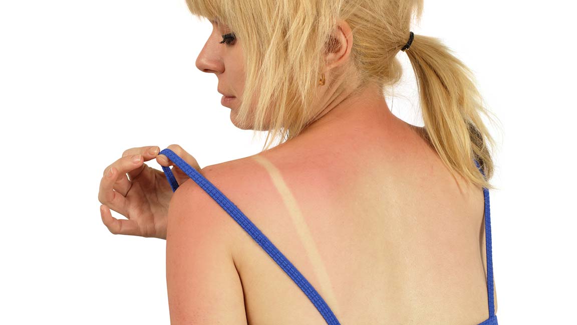 A woman examines sunburn on her shoulder