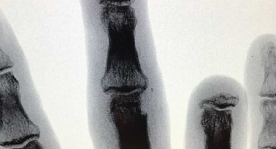An X-ray of Bobby Priest's injured hand after the accident that cost him his right ring finger.