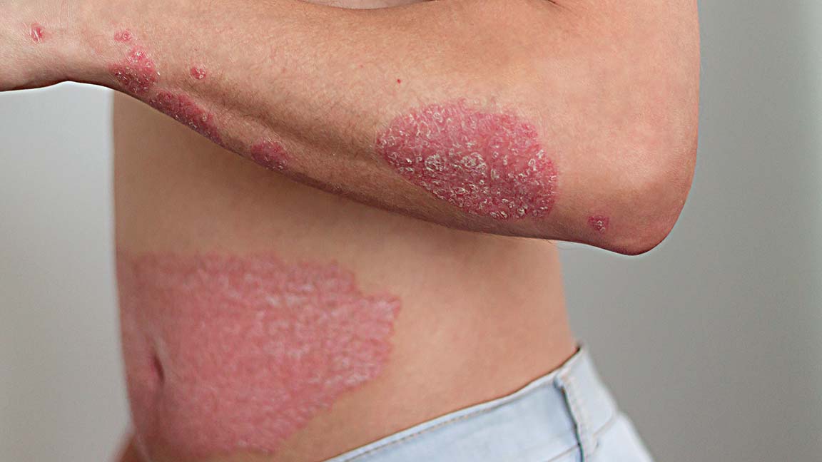 Man with itchy red spots