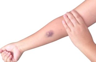 Bruised arm