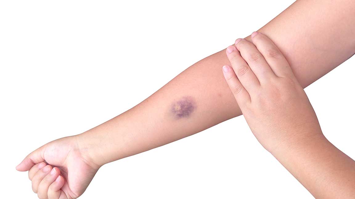Bruised arm