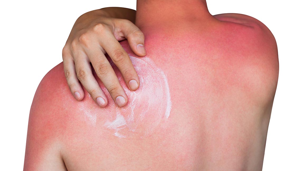 Man rubs cream on sunburn.