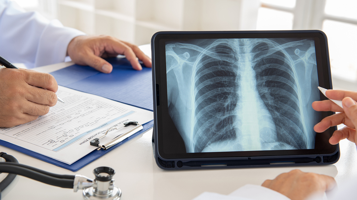 Lung X-ray