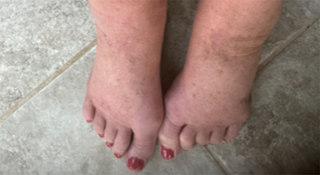 At times, the swelling in Shelley's Baiden's feet prevented her from wearing shoes.