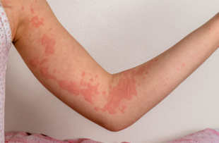 A girl´s arm with urticaria skin lesions (hives).