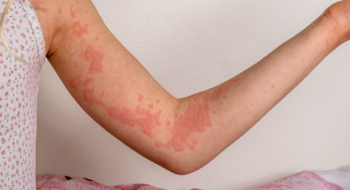 A girl´s arm with urticaria skin lesions (hives).