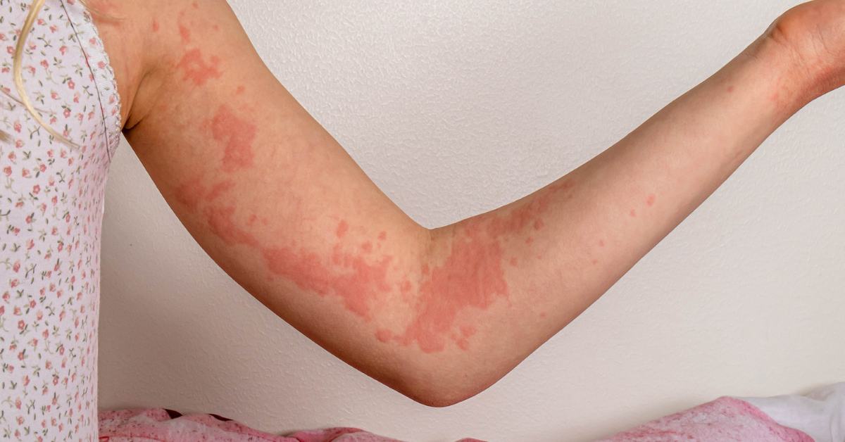 A girl´s arm with urticaria skin lesions (hives).