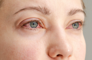 Close up of the red irritated human eyes, allergy symptom, conjunctivitis