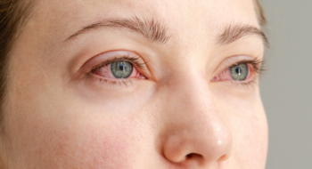Close up of the red irritated human eyes, allergy symptom, conjunctivitis