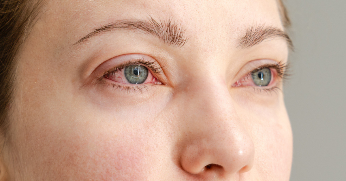Close up of the red irritated human eyes, allergy symptom, conjunctivitis