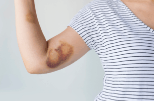 Bruise on woman arm.