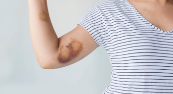 Bruise on woman arm.