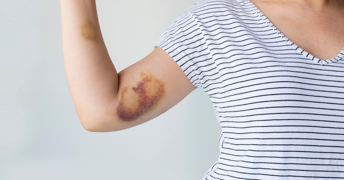 Bruise on woman arm.