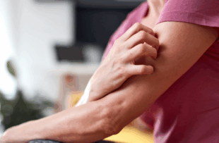 Woman with itchy, tingling arms scratching skin.