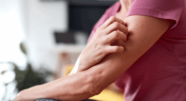 Woman with itchy, tingling arms scratching skin.