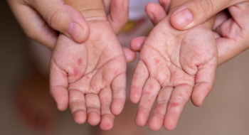 Parents hold the hands of a child with HFMD