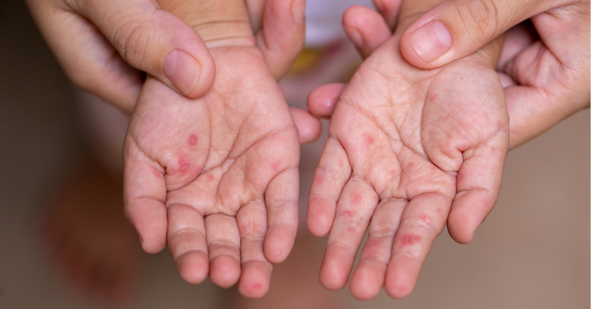 Parents hold the hands of a child with HFMD