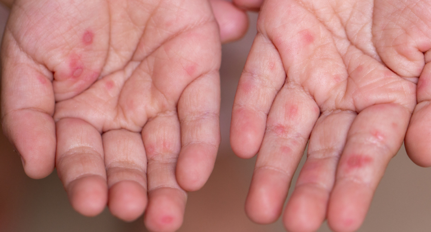 What to do if your kid gets hand, foot and mouth disease